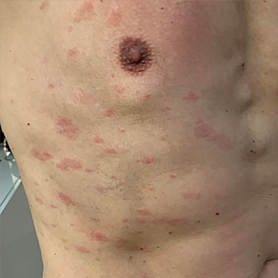 Pityriasis rosea